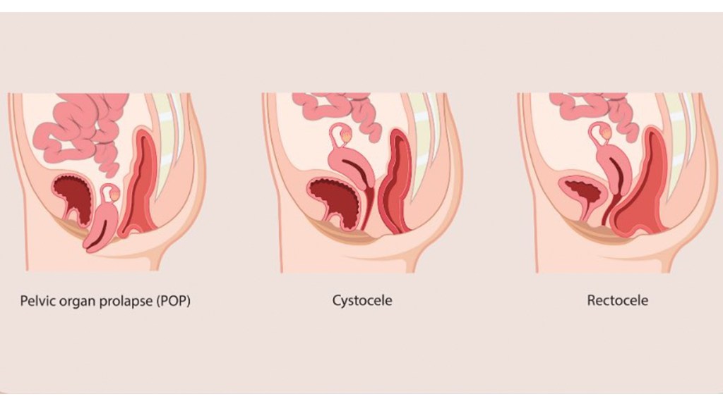 illustrations of rectocele, pelvic organ prolapse and cystocele