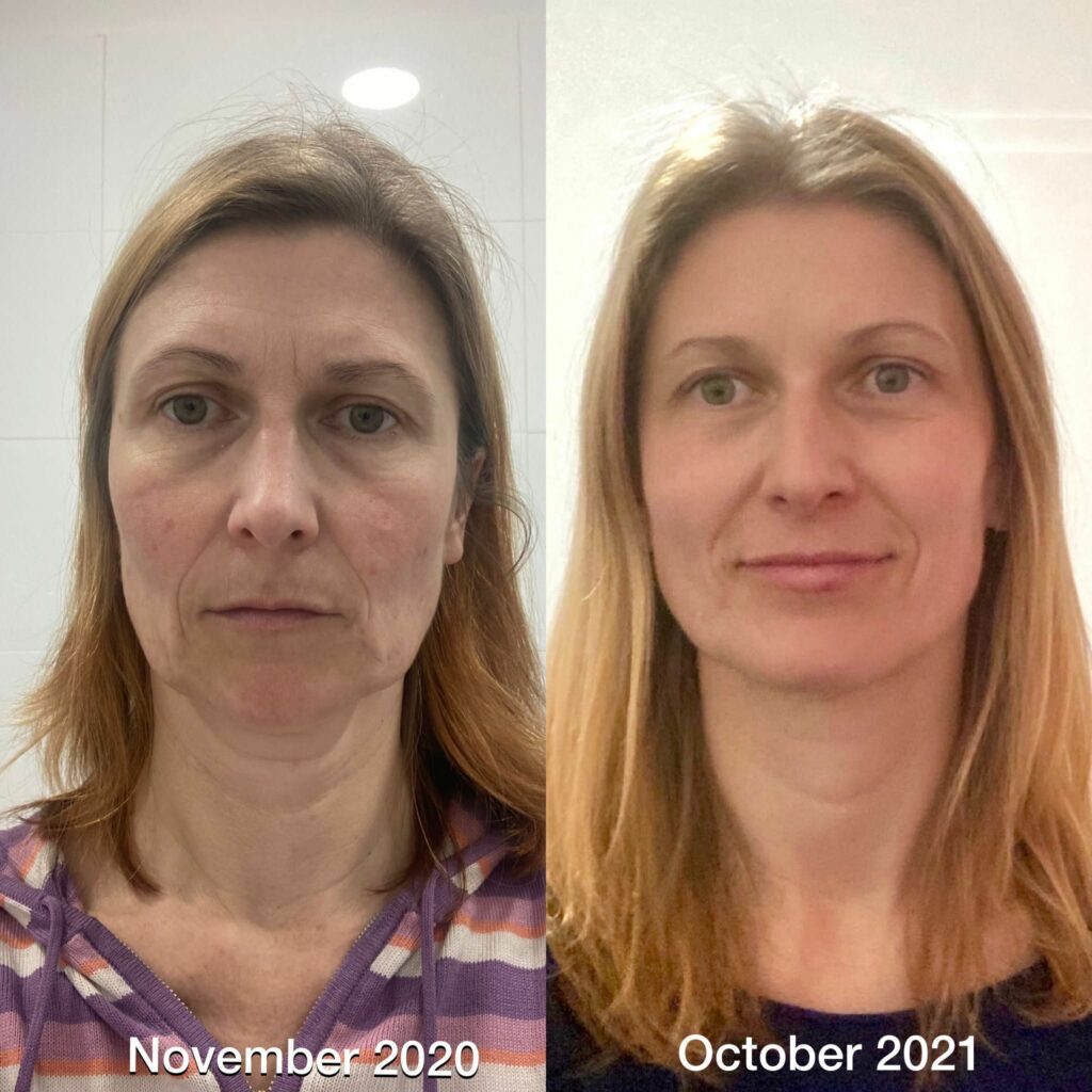 Mature woman before and after face yoga exercises