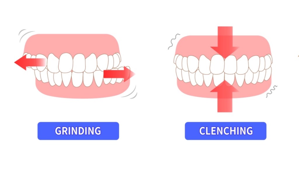 An illustration of bruxism, or clenching and grinding teeth