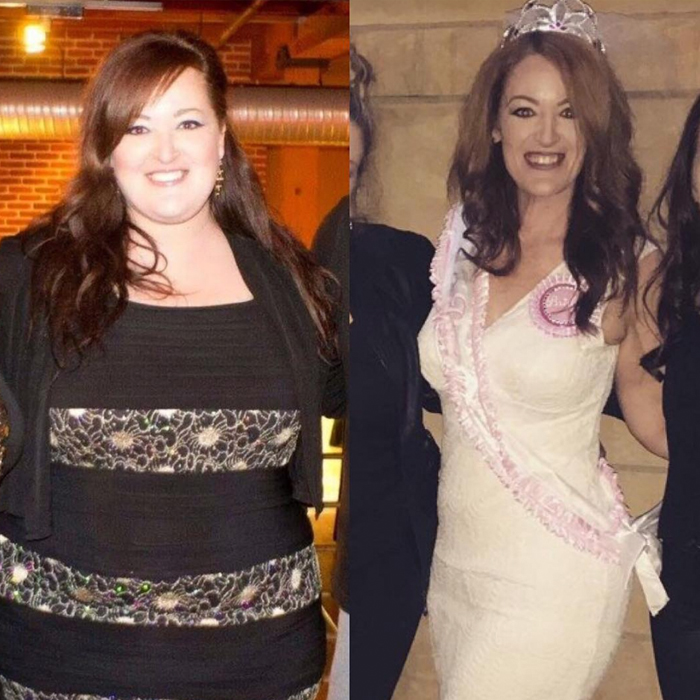 gastric sleeve journey before and after