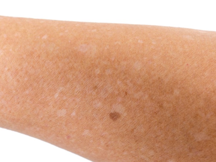 White spots on skin caused by a vitamin B12 deficiency