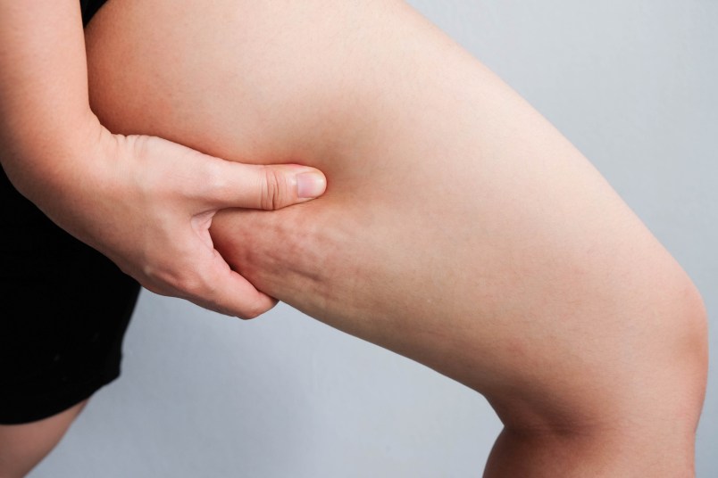 The Best Cellulite Cream To Reduce Unwanted Dimples