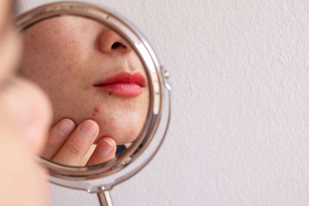 Woman looking at pimple in mirror and how to get rid of pimple redness
