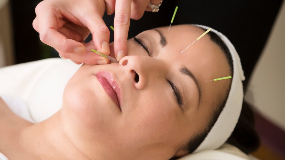 Woman getting acupuncture treatment on her face