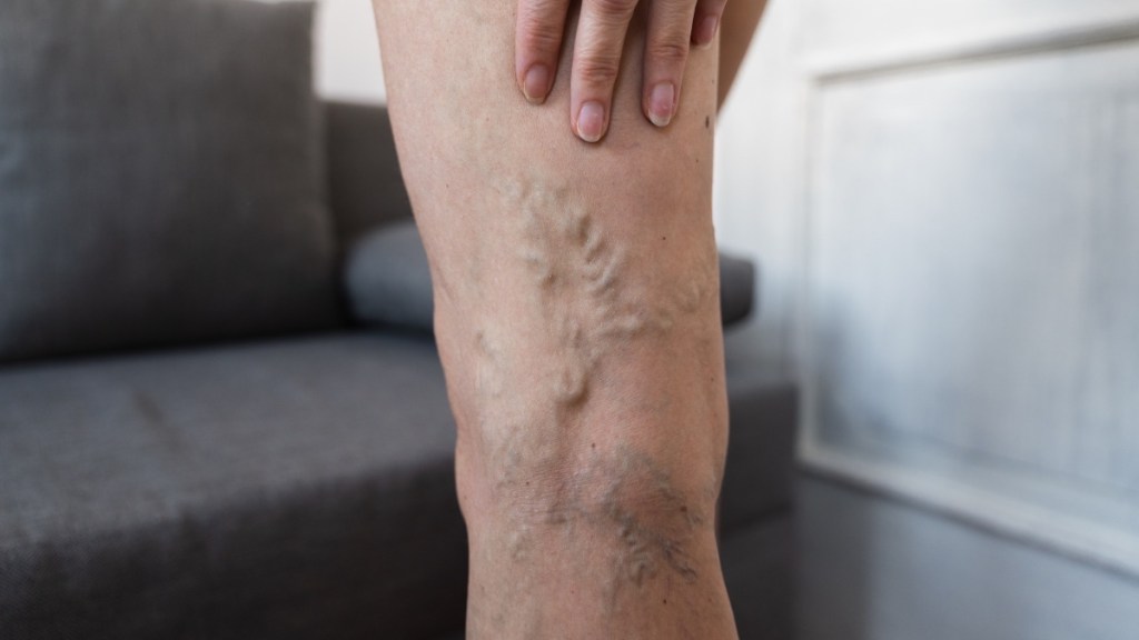 A close-up of a woman's leg with varicose veins