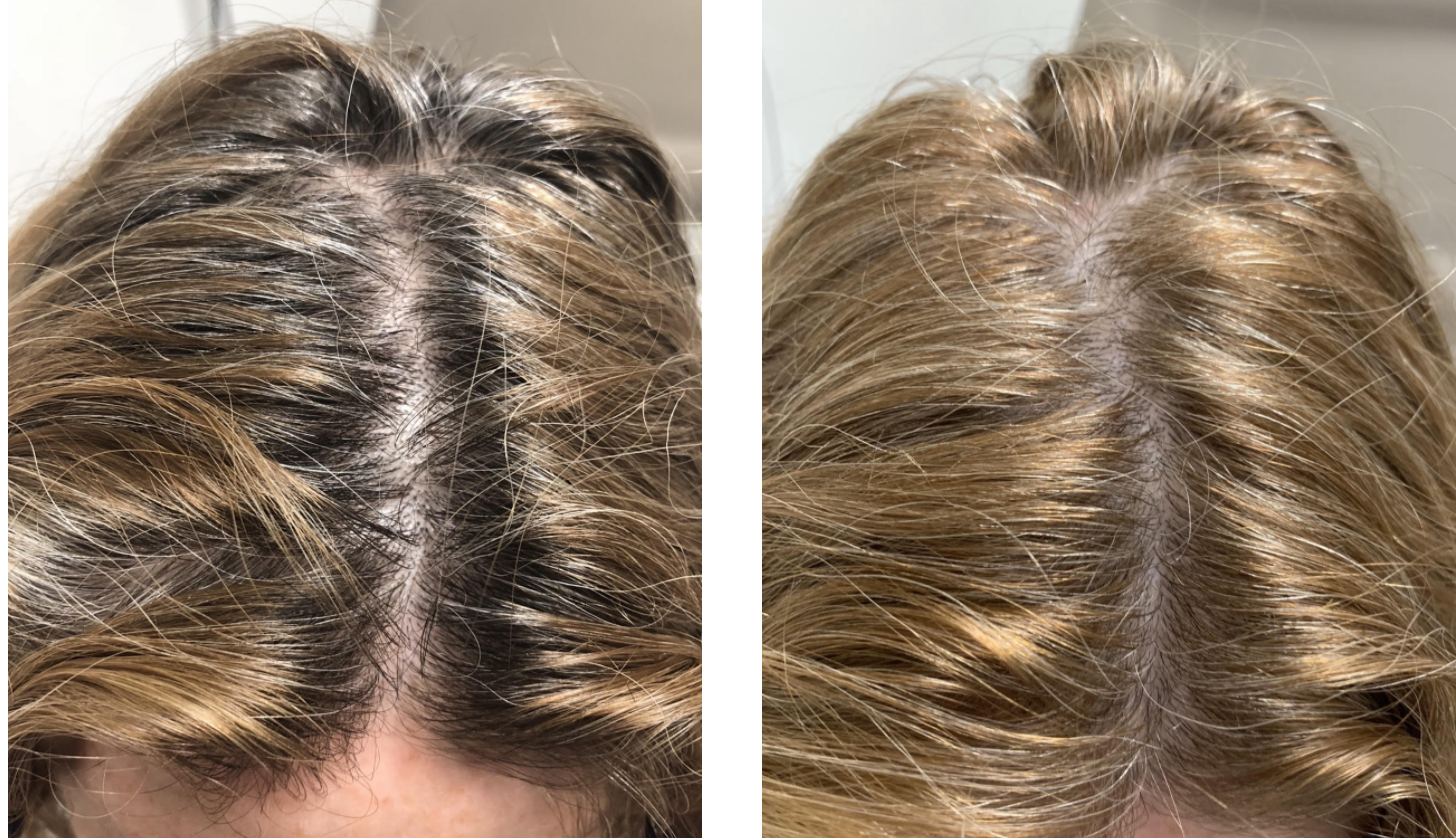 3 New Ways To Regrow Thinning Hair First For Women