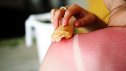 Woman applying remedy to sunburned back