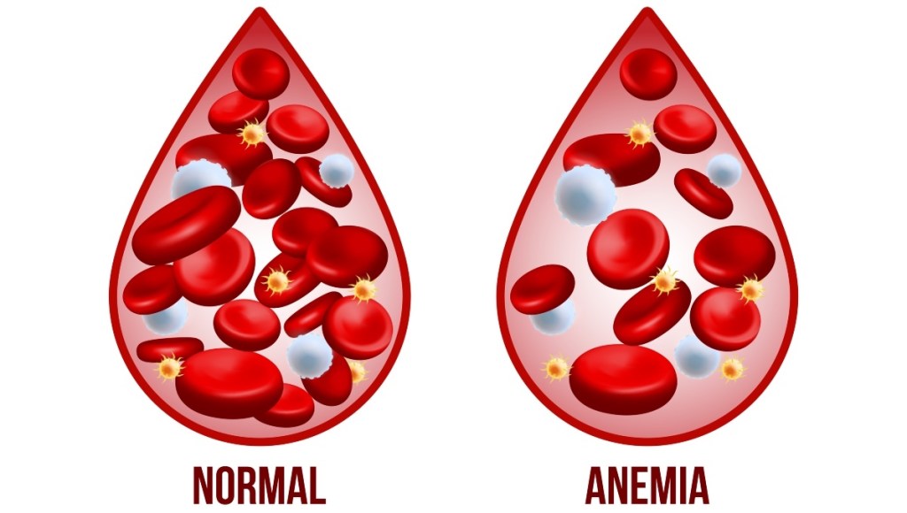 Anemia can be a sign of vitamin B12 deficiency