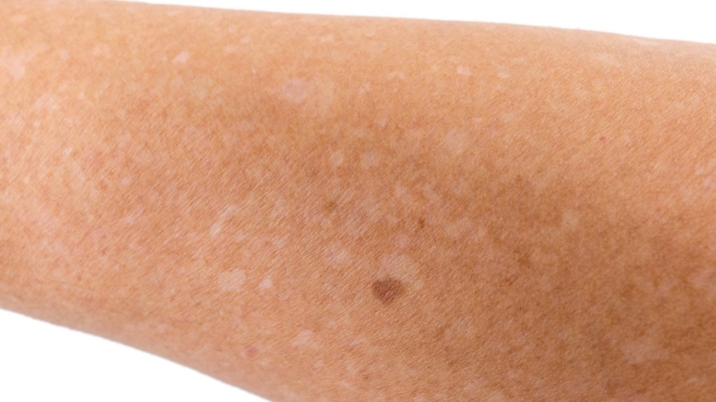 White spots on skin, signs of a vitamin B12 deficiency