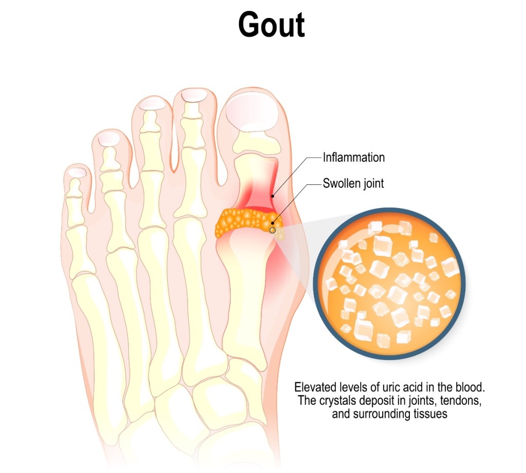 Tart cherry juice drinks for gout