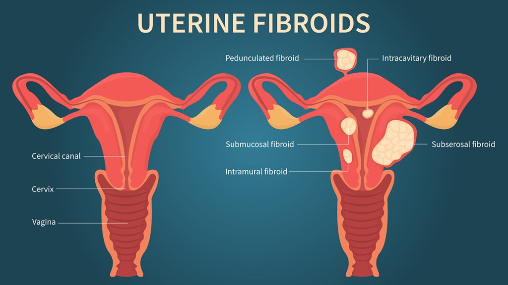 Uterine fibroid embolization can remove fibroids growing in the uterus