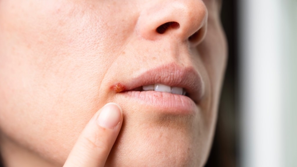 A woman pointing to a cold sore on her lip