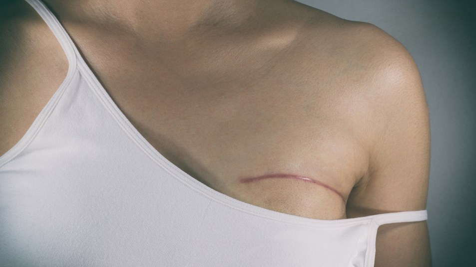 woman with mastectomy scar