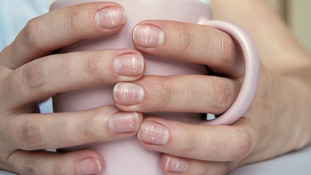 A close up of nails with white spots while a woman holds a pink mug