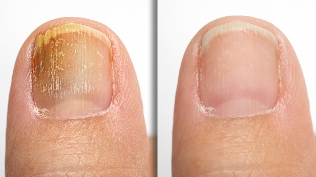 A nail with fungus and dents beside a healthy nail