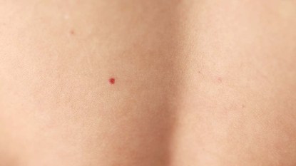 A woman with a red mole on her back
