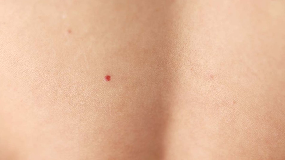 A woman with a red mole on her back