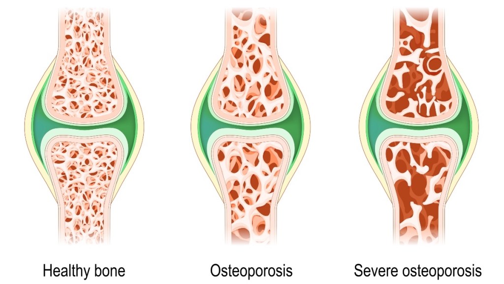 An illustration of three stages of osetoporosis, which causes brittle bones