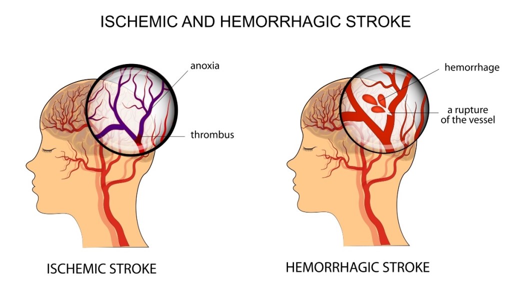 An illustration of ischemic and hemorrhagic strokes, which may be prevented with quercetin