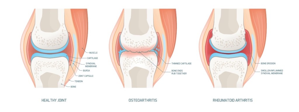 An illustration of joint cartilage