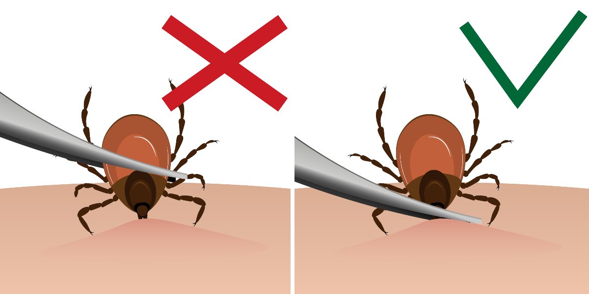 illustration of tick removal