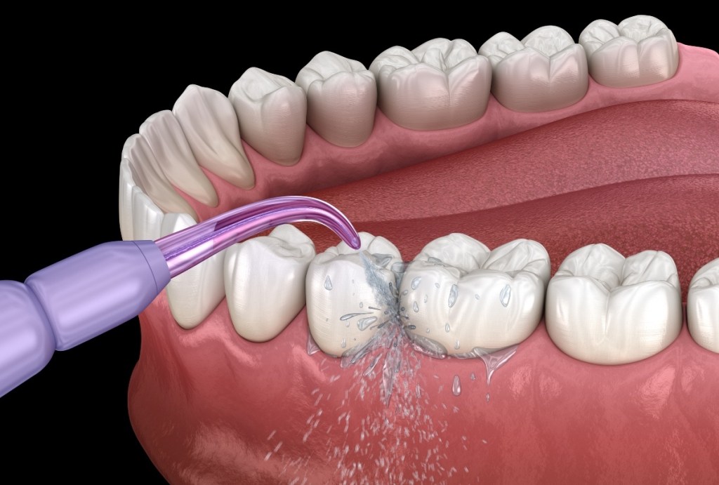 An illustration of a Waterpik cleaning between teeth