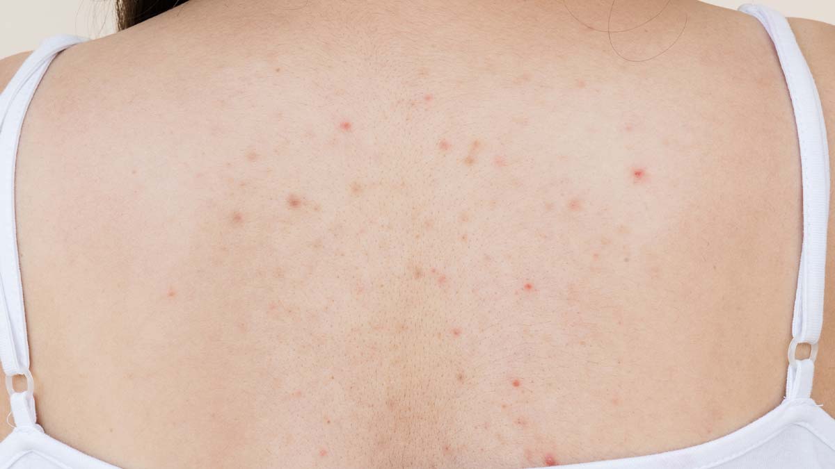 Some Causes of Your Body Acne and Skin Bumps | First For Women