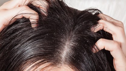 mature woman with a dry scalp