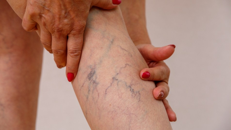 mature woman with hands surrounding varicose veins on her legs, sign of poor circulation