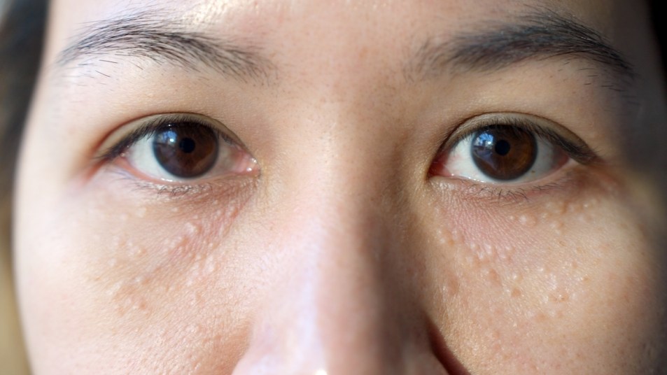 Close-up of woman's eyes with milia on skin below them