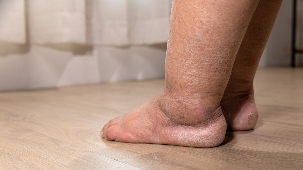 female swollen ankles pictures