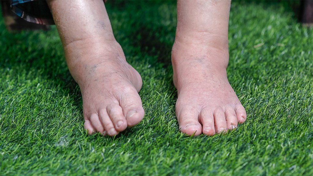female swollen ankles pictures