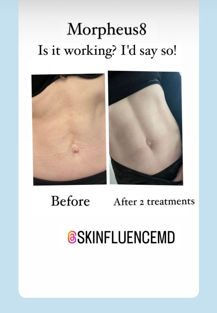 microneedling body before and after