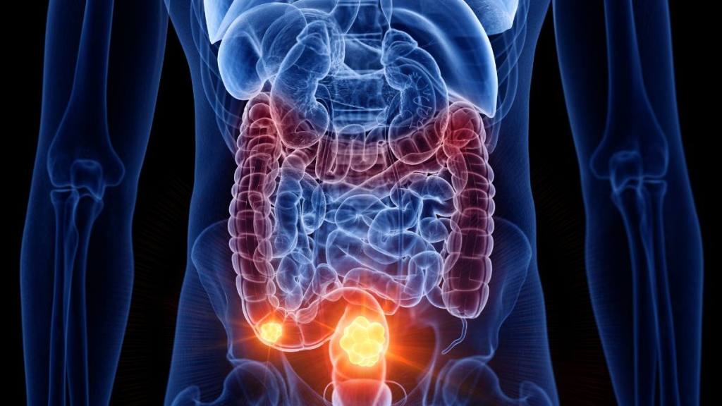The best foods to eat for gut health: Colon cancer, computer illustration.
