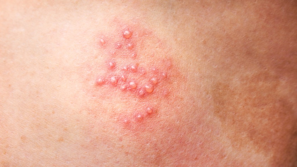 A close up of a shingles rash and blisters caused by the same virus that causes the chickenpox