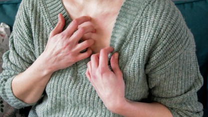 A close up of a woman in a green sweater scratching her chest due to shingles caused by chickenpox