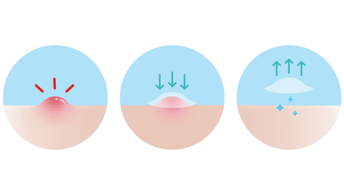 illustration of how pimple patches work