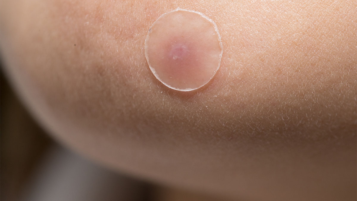pimple patch on woman's cheek