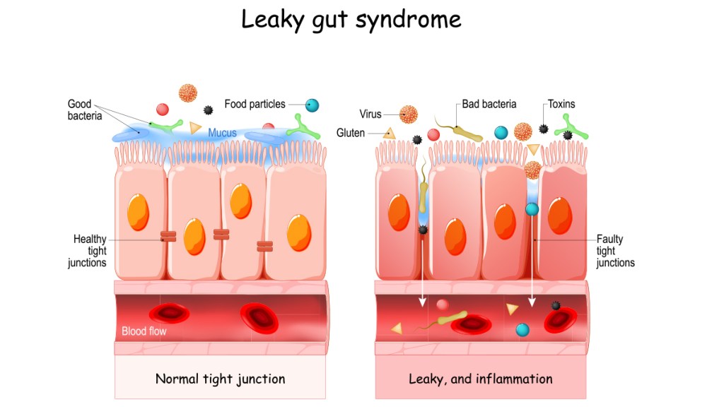 illustration of what happens with leaky gut