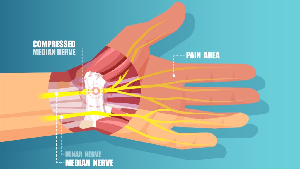 An illustration of carpal tunnel syndrome