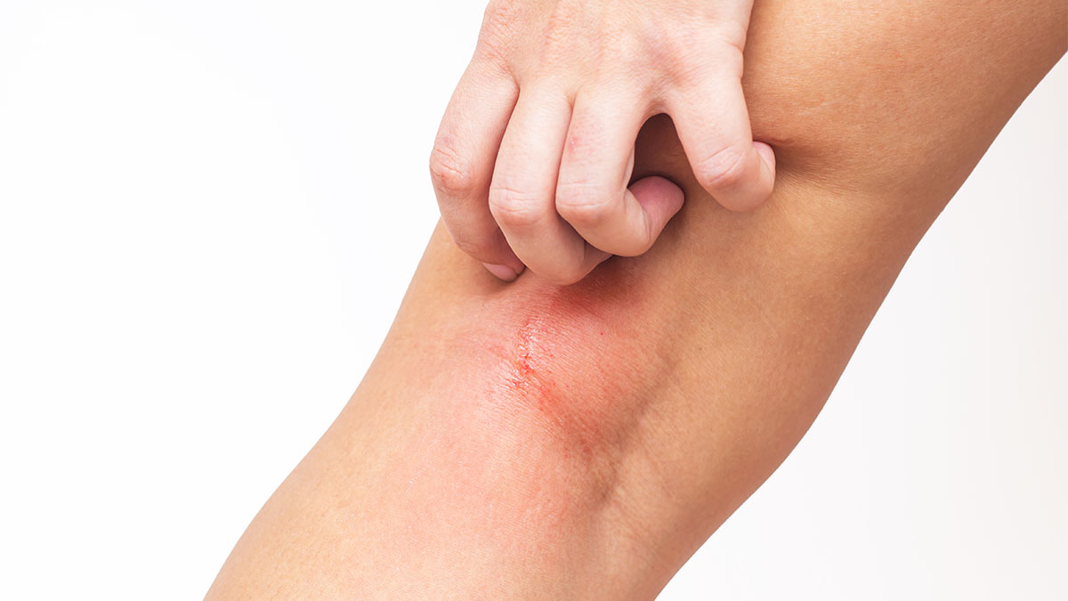 woman scratching eczema behind her knee