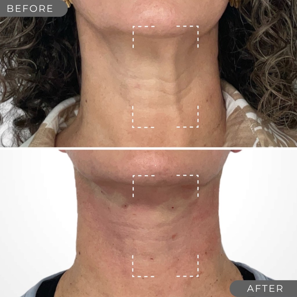 thread lift on neck before and after