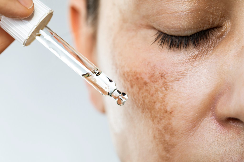 Woman applying serum to hyperpigmentation spots