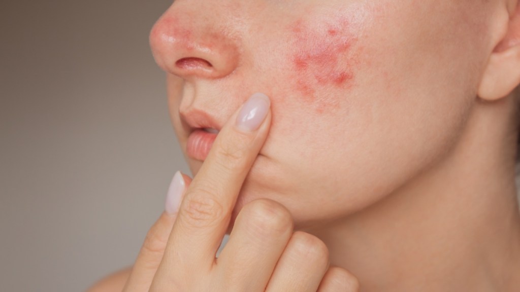 A woman pointing to redness on her face, trying to get rid of rosacea permanently