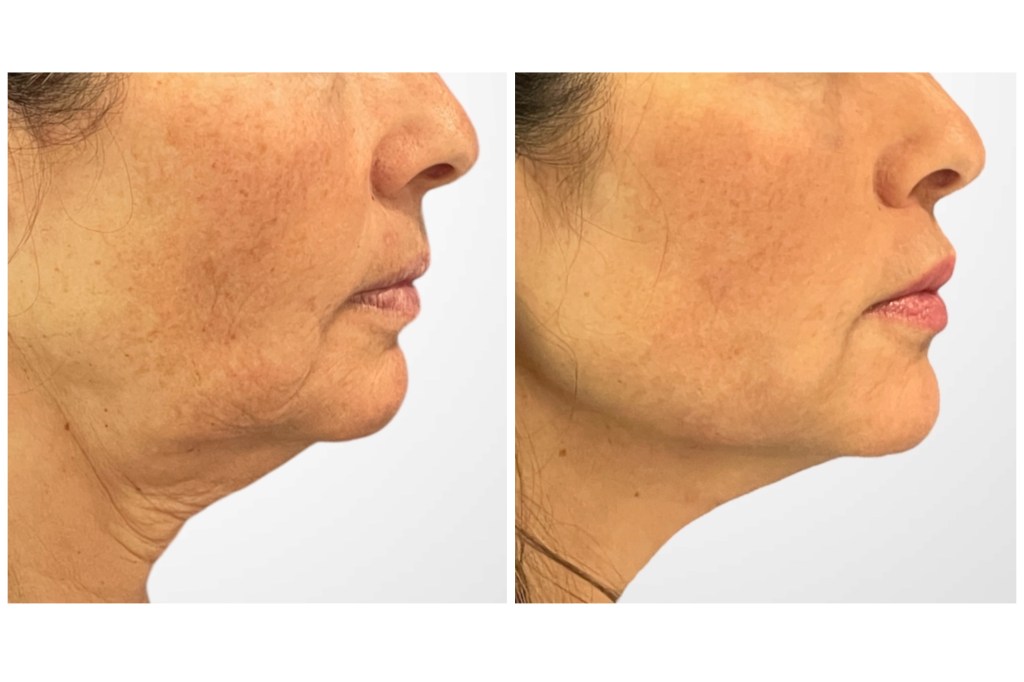 lower face thread lift before and after