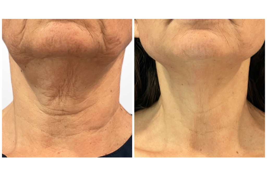 lower face thread lift before and after
