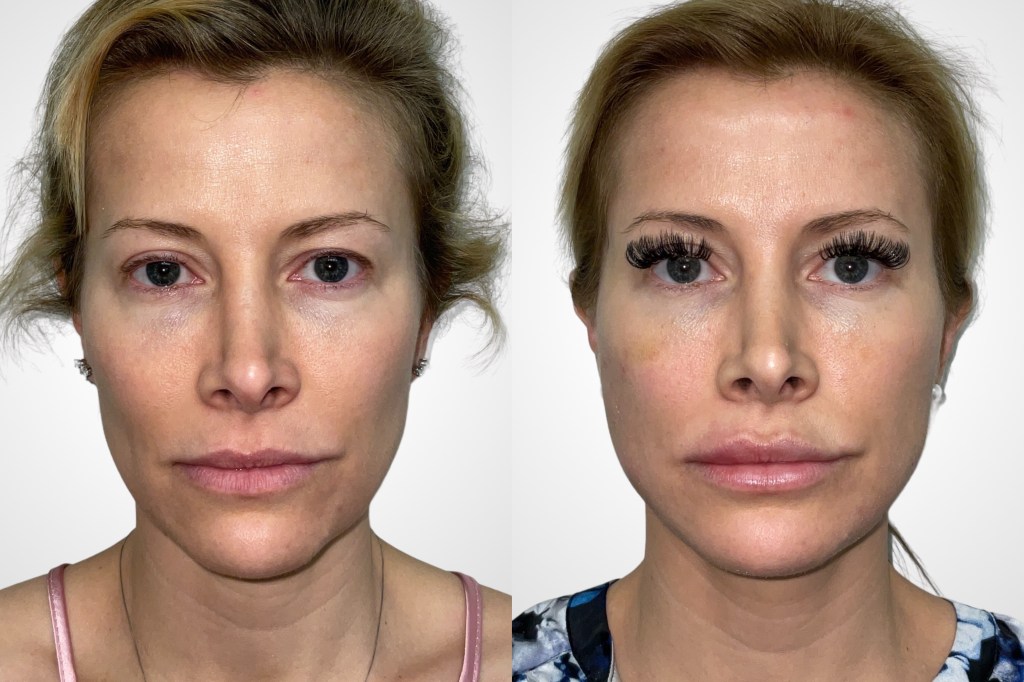thread lift on face before and after