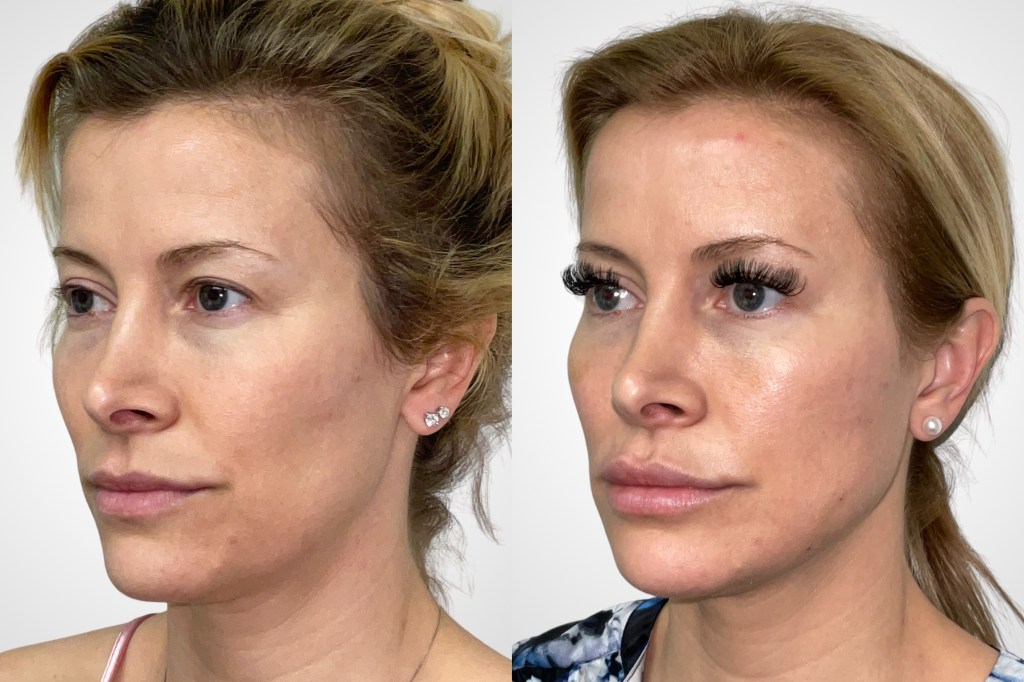 thread lift on face before and after