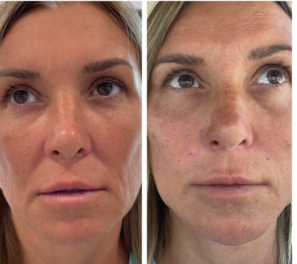 face thread lift before and after