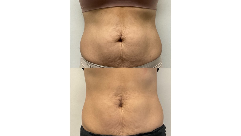 thread lift on tummy before and after